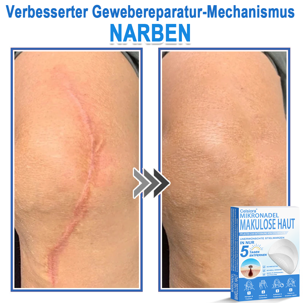 👨⚕️Celsiora® 2-in-1 Mikronadel- & Hydrokolloid-Pflaster | Entferner für erhabene Muttermale, Akne, flache Warzen & Hautanhängsel | Verbessert Falten, Narben & Hautunreinheiten | Unsichtbare Stern-Pickelpflaster für Gesicht & Körper