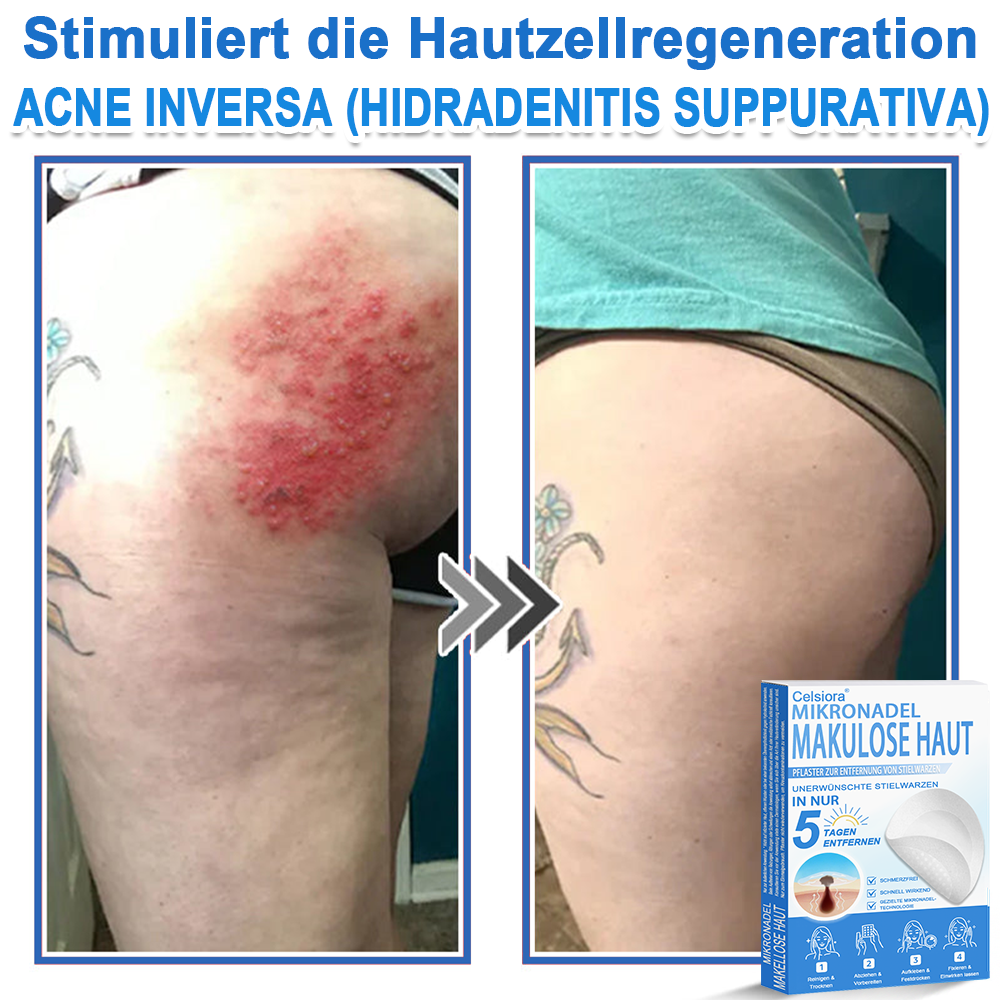 👨‍⚕️Celsiora® 2-in-1 Mikronadel- & Hydrokolloid-Pflaster | Entferner für erhabene Muttermale, Akne, flache Warzen & Hautanhängsel | Verbessert Falten, Narben & Hautunreinheiten | Unsichtbare Stern-Pickelpflaster für Gesicht & Körper