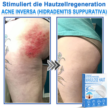 👨‍⚕️Celsiora® 2-in-1 Mikronadel- & Hydrokolloid-Pflaster | Entferner für erhabene Muttermale, Akne, flache Warzen & Hautanhängsel | Verbessert Falten, Narben & Hautunreinheiten | Unsichtbare Stern-Pickelpflaster für Gesicht & Körper