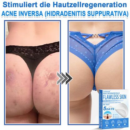📌 Celsiora® 2-in-1 Mikronadel- & Hydrokolloid-Pflaster | Entferner für erhabene Muttermale, Akne, flache Warzen & Hautanhängsel | Verbessert Falten, Narben & Hautunreinheiten | Unsichtbare Stern-Pickelpflaster für Gesicht & Körper