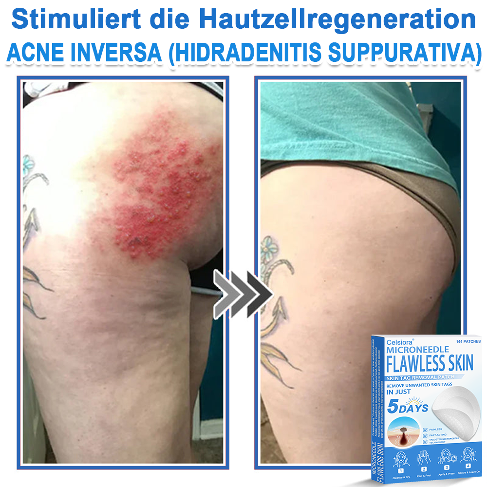 80%OFF 📌 Celsiora® 2-in-1 Mikronadel- & Hydrokolloid-Pflaster | Entferner für erhabene Muttermale, Akne, flache Warzen & Hautanhängsel | Verbessert Falten, Narben & Hautunreinheiten | Unsichtbare Stern-Pickelpflaster für Gesicht & Körper (Copy)