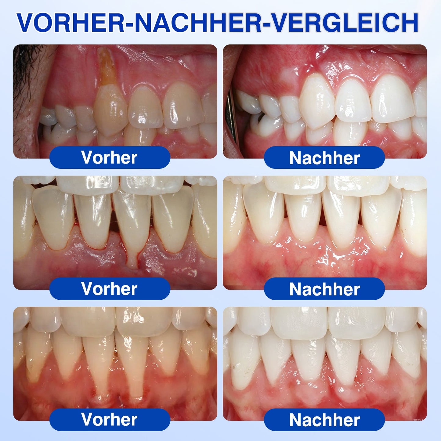🇩🇪👨‍⚕️✅🦷Evolvion® GumRevive Parodontales Reparaturgel