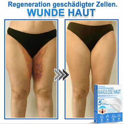 👨‍⚕️Celsiora® 2-in-1 Mikronadel- & Hydrokolloid-Pflaster | Entferner für erhabene Muttermale, Akne, flache Warzen & Hautanhängsel | Verbessert Falten, Narben & Hautunreinheiten | Unsichtbare Stern-Pickelpflaster für Gesicht & Körper