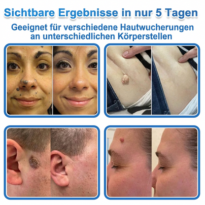 👨‍⚕️Celsiora® 2-in-1 Mikronadel- & Hydrokolloid-Pflaster | Entferner für erhabene Muttermale, Akne, flache Warzen & Hautanhängsel | Verbessert Falten, Narben & Hautunreinheiten | Unsichtbare Stern-Pickelpflaster für Gesicht & Körper