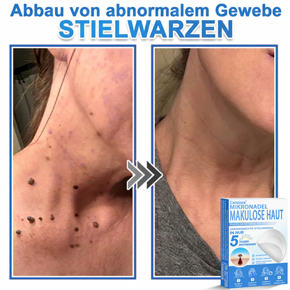 👨‍⚕️Celsiora® 2-in-1 Mikronadel- & Hydrokolloid-Pflaster | Entferner für erhabene Muttermale, Akne, flache Warzen & Hautanhängsel | Verbessert Falten, Narben & Hautunreinheiten | Unsichtbare Stern-Pickelpflaster für Gesicht & Körper