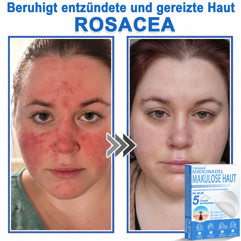 👨‍⚕️Celsiora® 2-in-1 Mikronadel- & Hydrokolloid-Pflaster | Entferner für erhabene Muttermale, Akne, flache Warzen & Hautanhängsel | Verbessert Falten, Narben & Hautunreinheiten | Unsichtbare Stern-Pickelpflaster für Gesicht & Körper