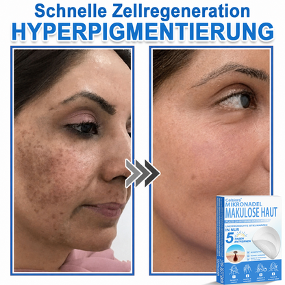 👨‍⚕️Celsiora® 2-in-1 Mikronadel- & Hydrokolloid-Pflaster | Entferner für erhabene Muttermale, Akne, flache Warzen & Hautanhängsel | Verbessert Falten, Narben & Hautunreinheiten | Unsichtbare Stern-Pickelpflaster für Gesicht & Körper