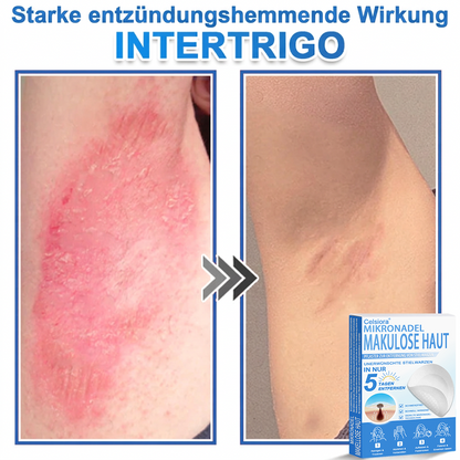 👨‍⚕️Celsiora® 2-in-1 Mikronadel- & Hydrokolloid-Pflaster | Entferner für erhabene Muttermale, Akne, flache Warzen & Hautanhängsel | Verbessert Falten, Narben & Hautunreinheiten | Unsichtbare Stern-Pickelpflaster für Gesicht & Körper