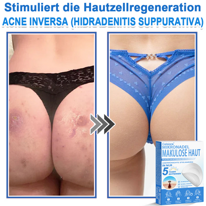 👨‍⚕️Celsiora® 2-in-1 Mikronadel- & Hydrokolloid-Pflaster | Entferner für erhabene Muttermale, Akne, flache Warzen & Hautanhängsel | Verbessert Falten, Narben & Hautunreinheiten | Unsichtbare Stern-Pickelpflaster für Gesicht & Körper