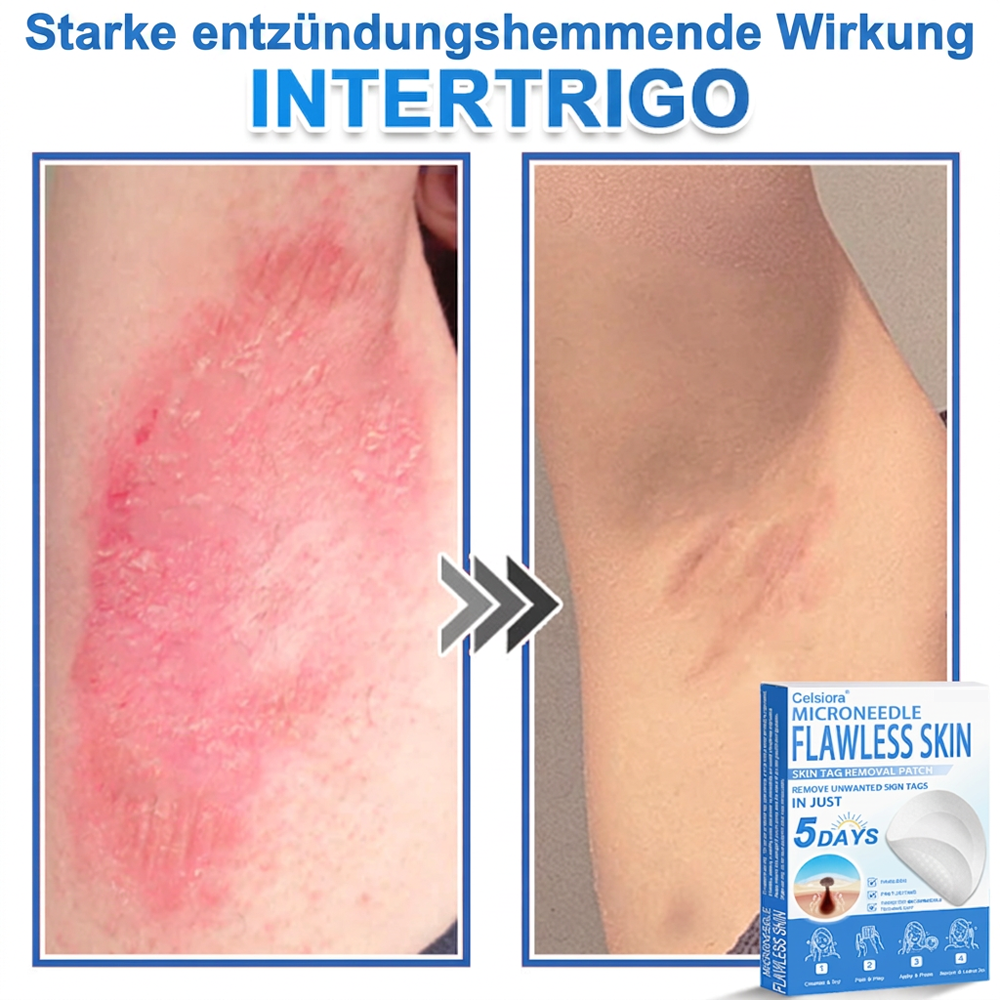 80%OFF 📌 Celsiora® 2-in-1 Mikronadel- & Hydrokolloid-Pflaster | Entferner für erhabene Muttermale, Akne, flache Warzen & Hautanhängsel | Verbessert Falten, Narben & Hautunreinheiten | Unsichtbare Stern-Pickelpflaster für Gesicht & Körper (Copy)